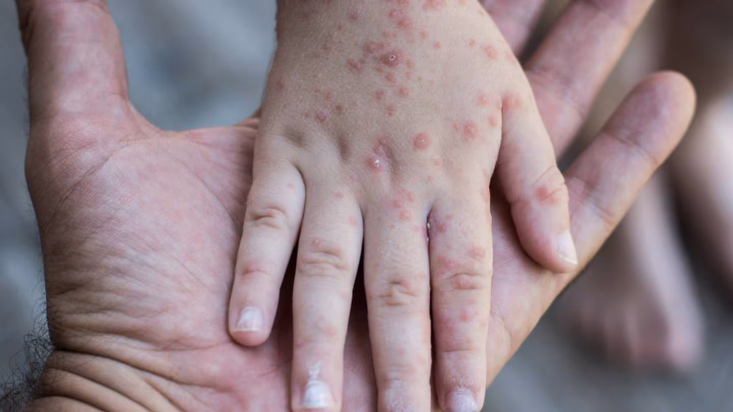 OMS declara a la viruela del mono, mpox, como emergencia mundial de salud